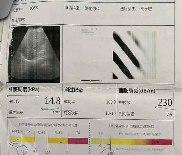 郑州哪个医院治疗肝硬化?郑州哪里看肝硬化好