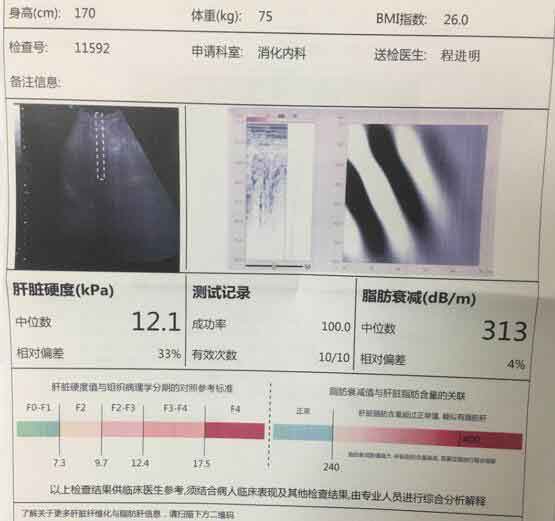 郑州看肝硬化哪个医院好?郑州治疗肝硬化几家医院好