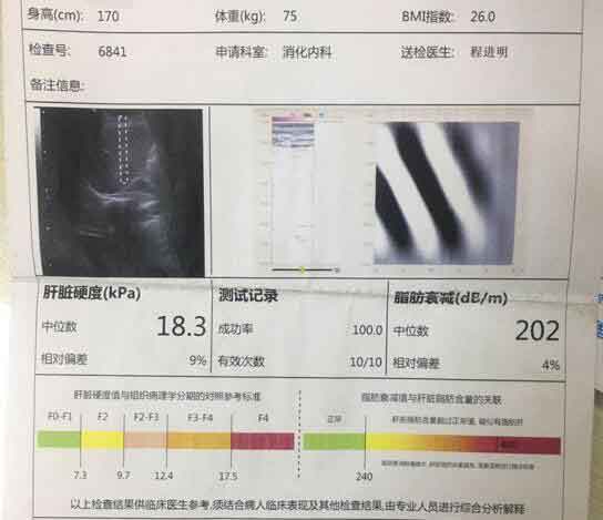 郑州看肝硬化哪个医院好?郑州治疗肝硬化几家医院好